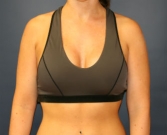 Feel Beautiful - Breast Augmentation San Diego Case 53a - After Photo